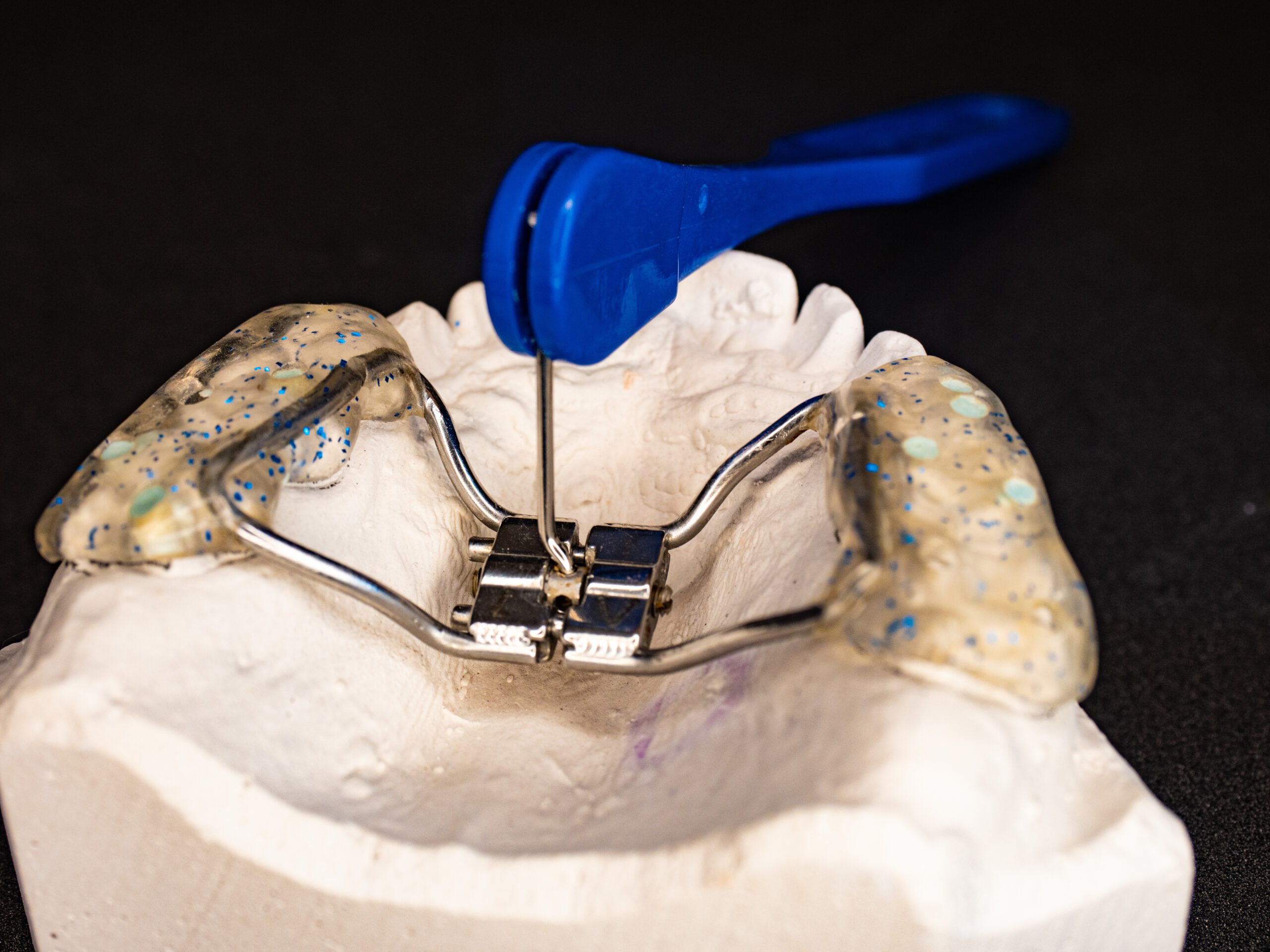 Ahava Orthodontics palatal expander for jaw repositioning