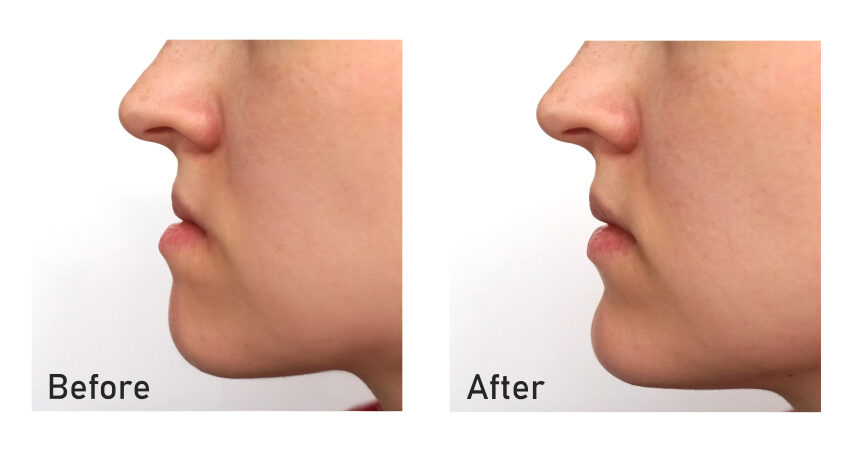 what is orthognathic surgery