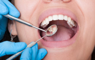 How Common Are Cavities After Braces?