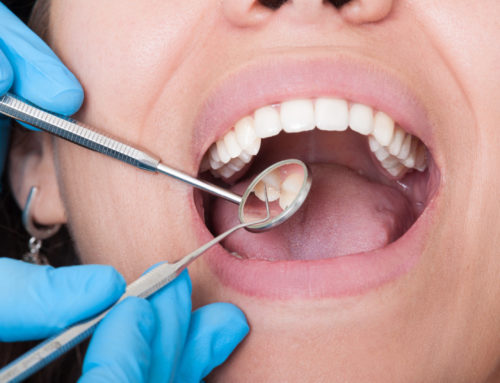 How Common Are Cavities After Braces?
