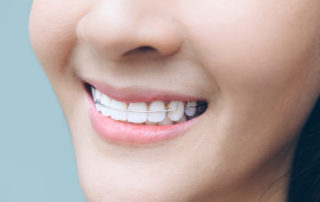 orthodontic retention fort worth
