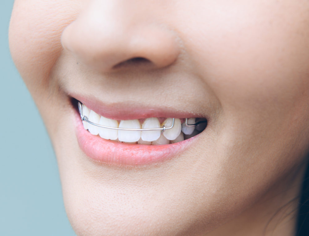 What To Do When You Have a Broken Retainer Ahava Orthodontics