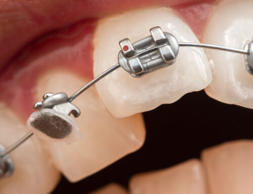 What To Do If You Have Broken Braces