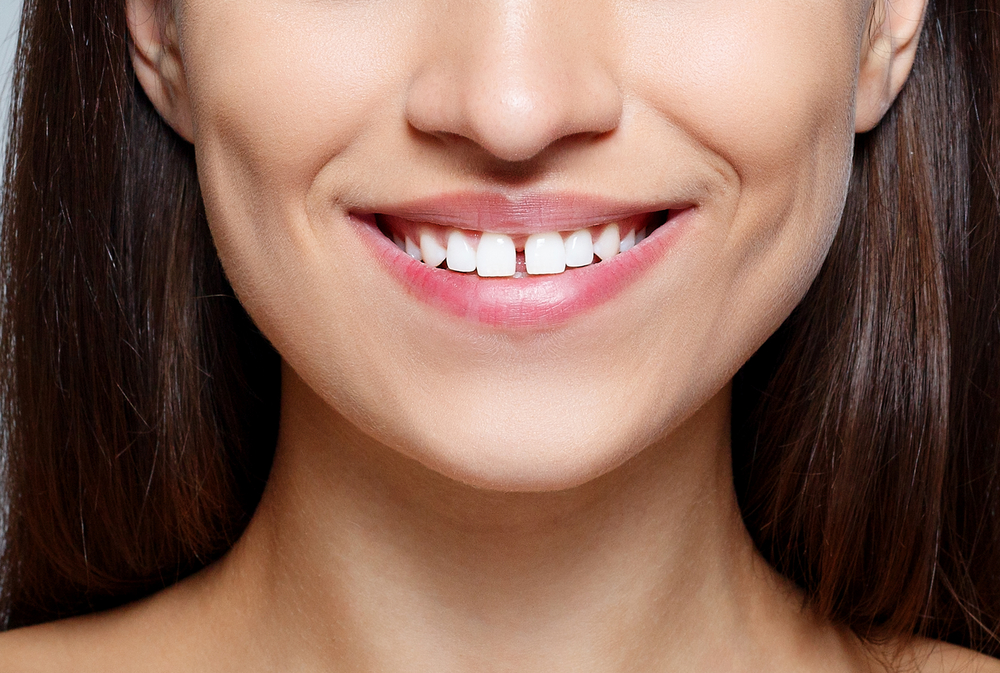 Can Braces Fix Gaps in Teeth