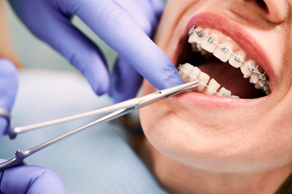 Choosing an Orthodontist vs. a Regular Dentist for Orthodontics