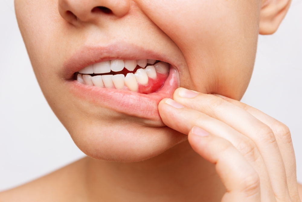 Impact of Gum Disease on Jawbone and Teeth Alignment