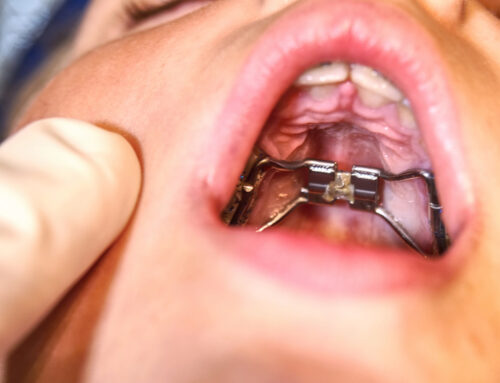 Palatal Expanders in Fort Worth