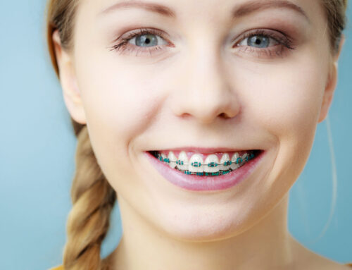 Braces and Aligners for Crowded Teeth
