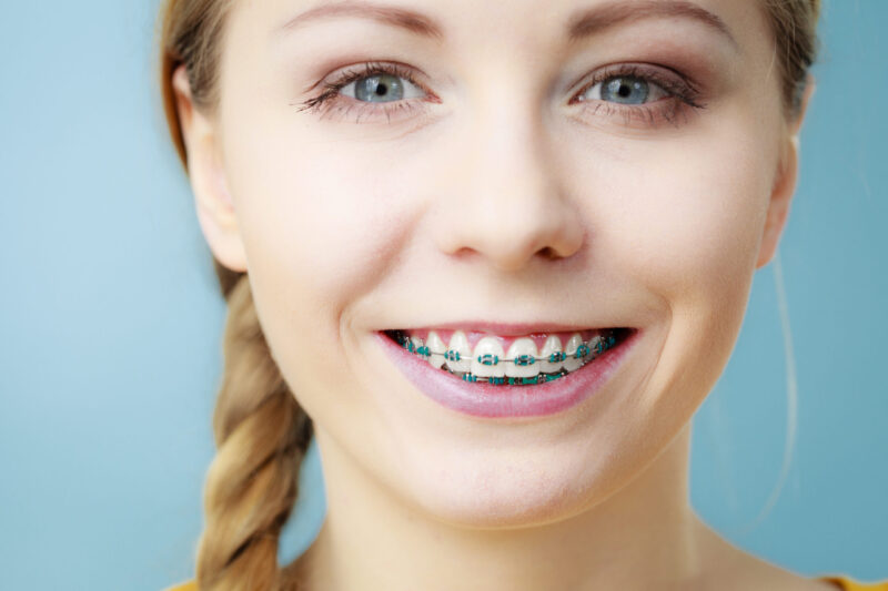 Braces and Aligners for Crowded Teeth | Ahava Orthodontics