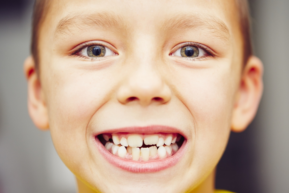 Why Do Teeth Overlap