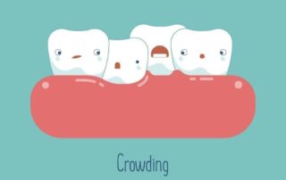 Teeth Crowding: Symptoms, Diagnosis, & Treatment