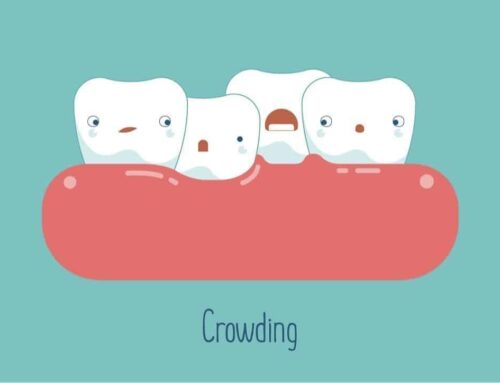 Diagnosing Teeth Crowding
