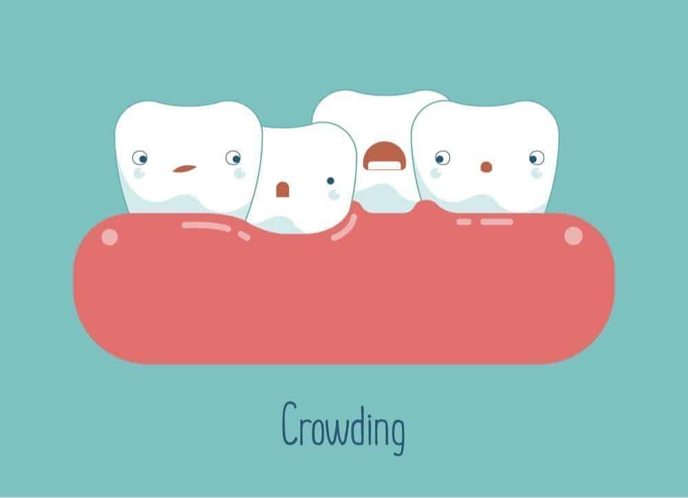 Teeth Crowding: Symptoms, Diagnosis, & Treatment