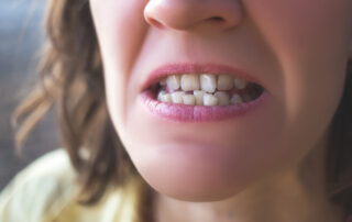 Long-Term Effects of Not Getting Braces When You Need Them