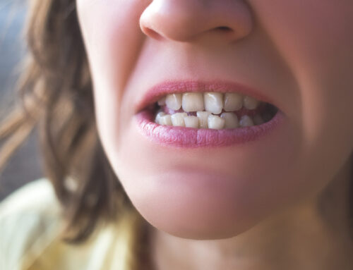 Long-Term Effects of Not Getting Braces When You Need Them