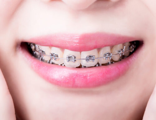 Naturally Straighten Teeth: Why Braces Are Your Best Option