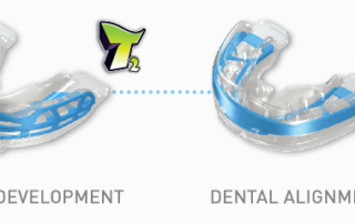 myobrace treatment stages