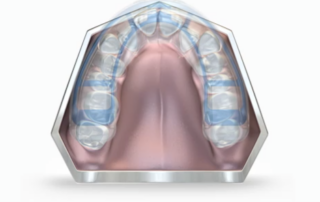 How the Myobrace Helps with Health and Development