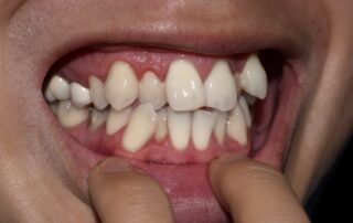 Genetic Factors Impacting Teeth Alignment