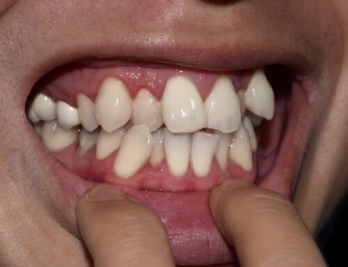 Genetic Factors Impacting Teeth Alignment