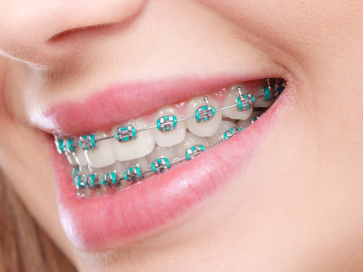 How Much Do Braces Cost In Dominican Republic How Much Do Braces Cost in 2025 | Ahava Orthodontics
