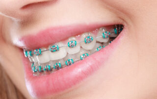 How Much Do Braces Cost in 2025