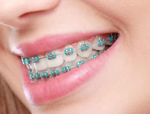 How Much Do Braces Cost in 2025