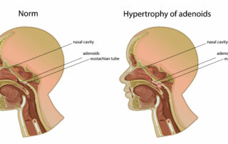 If Your Child is a Mouth Breather, They're at Risk of Swollen Adenoids