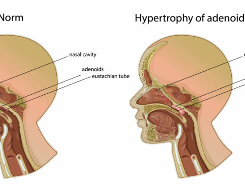 If Your Child is a Mouth Breather, They’re at Risk of Swollen Adenoids