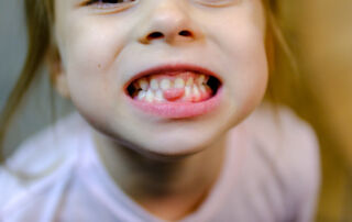 My Child’s Teeth Are Crowding