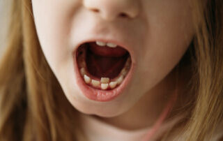 What Causes Misaligned Teeth in Children and How to Treat It Early
