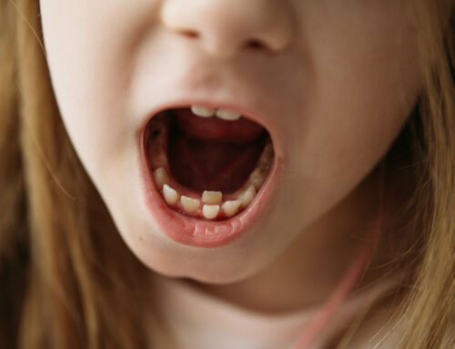 What Causes Misaligned Teeth in Children and How to Treat It Early