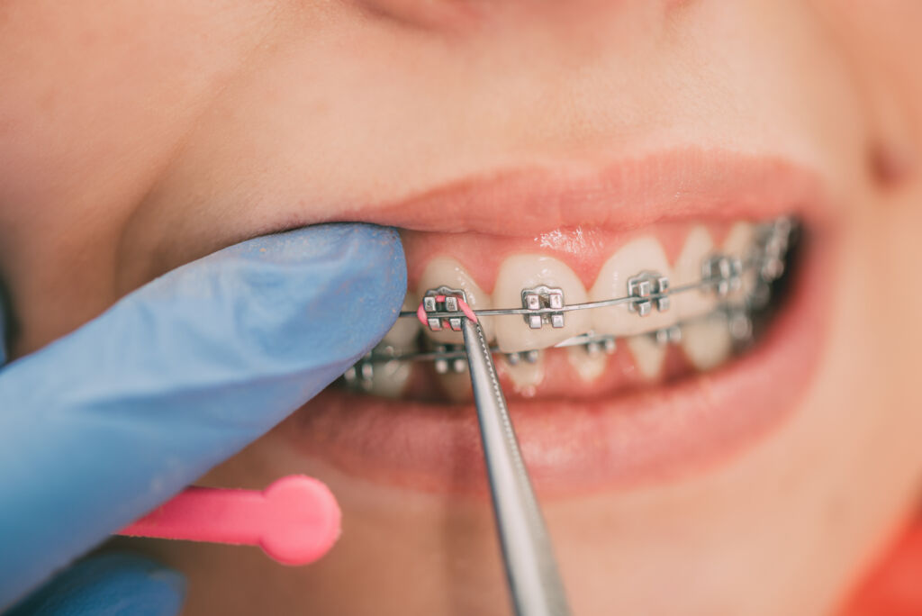 Where to Get Your Braces Fixed in Fort Worth