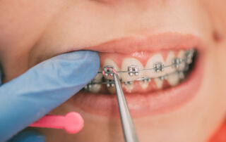 Where to Get Your Braces Fixed in Fort Worth