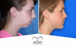 Jaw Repositioning Treatment in Fort Worth