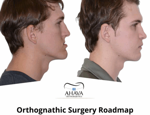 Orthognathic Surgery Roadmap: Before, During, and After