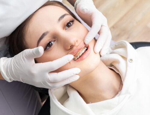 How Long Do Braces Take to Straighten Your Teeth